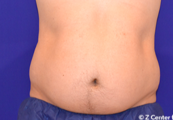 25-34 year old man treated with CoolSculpting before 1713747
