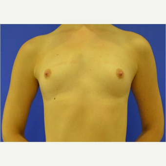 23 year old woman treated with Breast Augmentation before 3725696