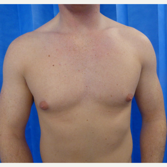 18-24 year old man treated with Male Breast Reduction before 3428605