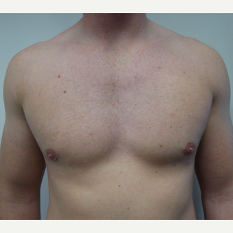 18-24 year old man treated with Male Breast Reduction after 3428605