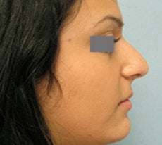Rhinoplasty before 132703