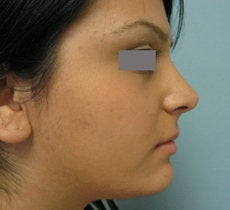 Rhinoplasty after 132703