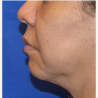 45-54 year old woman receives chin implant before 3763707