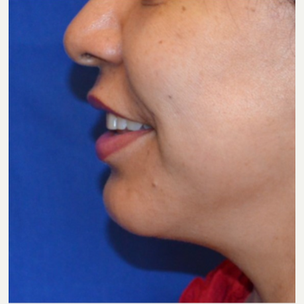 45-54 year old woman receives chin implant after 3763707