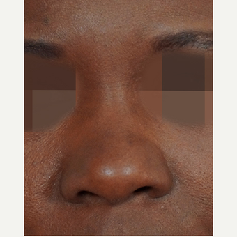 35-44 year old woman treated with Non Surgical Nose Job before 3244908