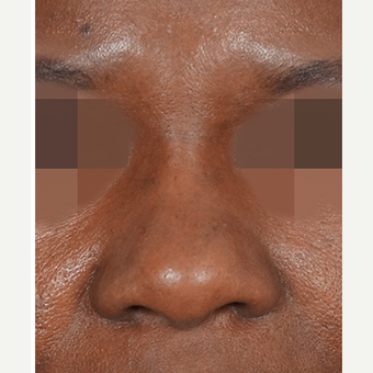 35-44 year old woman treated with Non Surgical Nose Job after 3244908