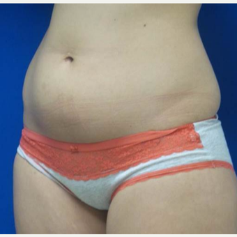 18-24 year old woman treated with CoolSculpting before 2833505