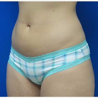 18-24 year old woman treated with CoolSculpting after 2833505