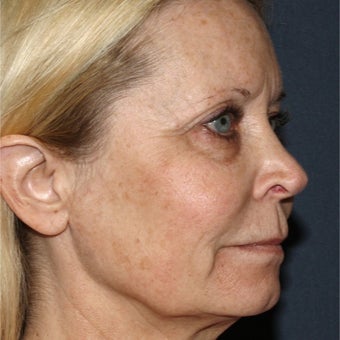 64 year old woman treated with Laser Resurfacing before 1786310