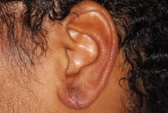 Split earlobe repair after 129544