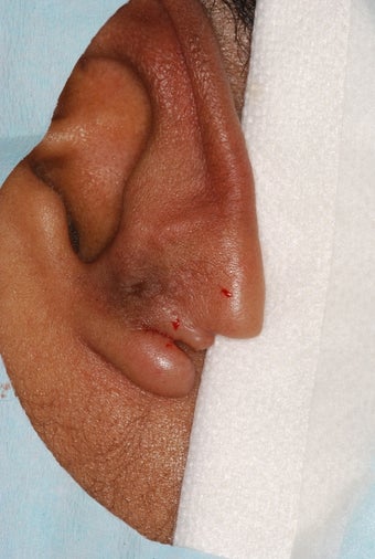 Split earlobe repair before 129544