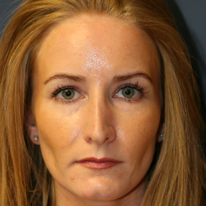 35-44 year old woman treated with Rhinoplasty before 3559715