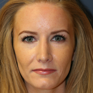 35-44 year old woman treated with Rhinoplasty after 3559715