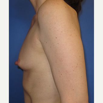 45-54 year old woman treated with Breast Augmentation (R. 286cc, L. 304cc) before 3309838