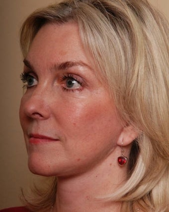 Necklift after 1018062