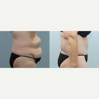 Body Lift 66 yr old Female after 3294531
