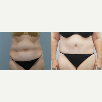 Body Lift 66 yr old Female before 3294531