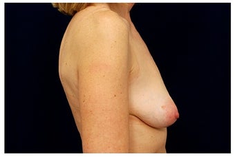 Breast Implants before 1332531
