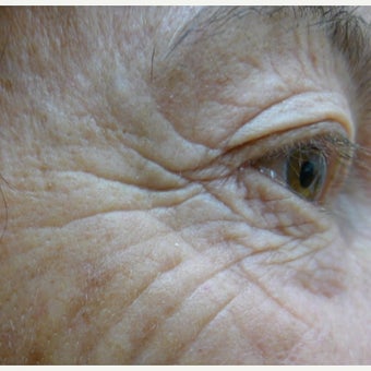 65-74 year old woman treated with Laser Resurfacing before 1584404
