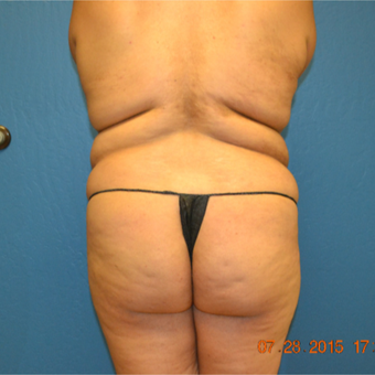 18-24 year old woman treated with Fat Transfer before 3611005