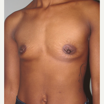25-34 year old woman treated with Breast Augmentation before 3756781