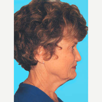 Facelift before 3826901