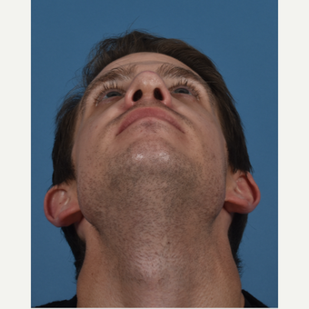 25-34 year old man treated with Revision Rhinoplasty after 3434542
