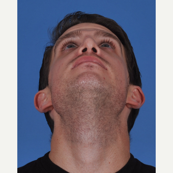 25-34 year old man treated with Revision Rhinoplasty before 3434542