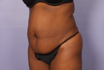 No Drain Tummy Tuck before 1195888