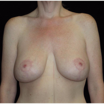 41 year old woman treated with Breast Lift with Implants after 3092830