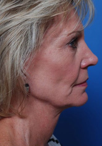 Woman with hollow cheeks seeking permanent cheek augmentation 1287703