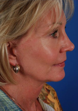 Woman with hollow cheeks seeking permanent cheek augmentation 1287703