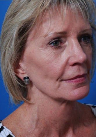 Woman with hollow cheeks seeking permanent cheek augmentation before 1287703