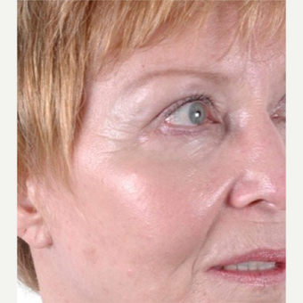 55 year old female patient treated with combination procedures for wrinkles and skin/tissue laxity 1663489