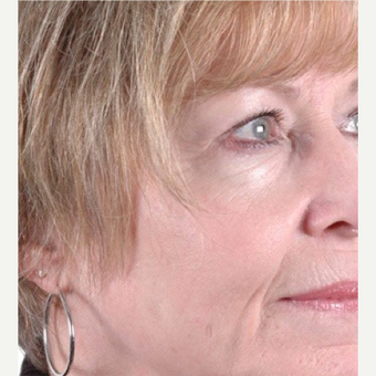 55 year old female patient treated with combination procedures for wrinkles and skin/tissue laxity 1663489