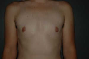 FTM top surgery. Keyhole approach with areola resizing and nipple reduction. after 1130788