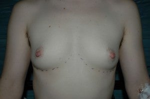 FTM top surgery. Keyhole approach with areola resizing and nipple reduction. before 1130788