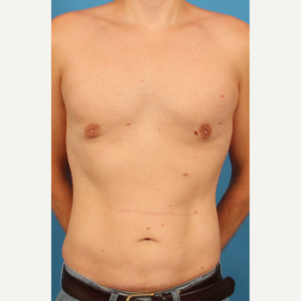 35 year old man treated with Male Breast Reduction + Liposuction to flanks, abdomen and upper back after 3298153