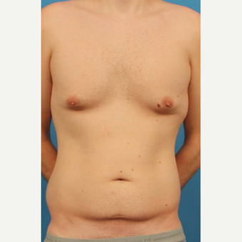 35 year old man treated with Male Breast Reduction + Liposuction to flanks, abdomen and upper back before 3298153