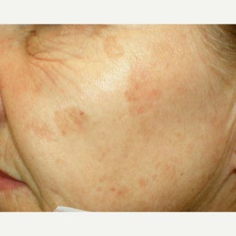 The days of TCA Peels before 1769830