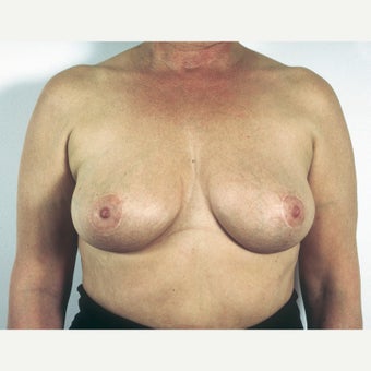 45-54 year old woman treated with Breast Implant Removal and Mastopexy after 1817208