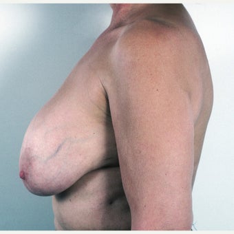 45-54 year old woman treated with Breast Implant Removal and Mastopexy 1817208