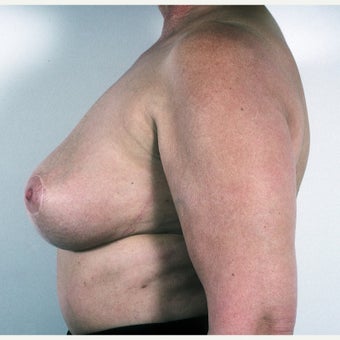 45-54 year old woman treated with Breast Implant Removal and Mastopexy 1817208