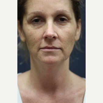 44 year old woman treated with Laser Peel before 3724344