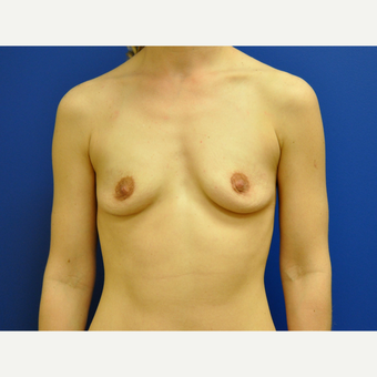 25-34 year old woman treated with Breast Augmentation before 3406680
