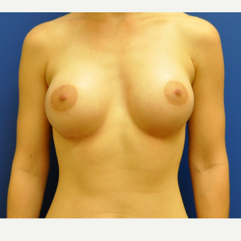 25-34 year old woman treated with Breast Augmentation after 3406680