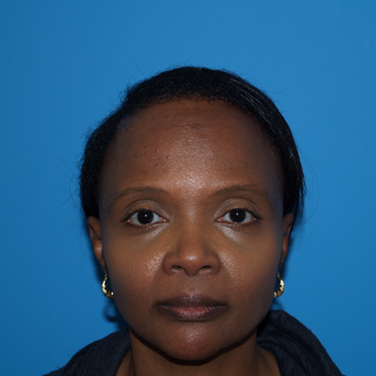 Traction injury alopecia after 3035927