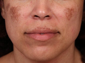 Cosmelan and Laser for Melasma before 1355789