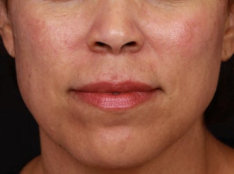 Cosmelan and Laser for Melasma after 1355789