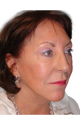 Facelift, necklift, upper & lower blepharoplasty 526457